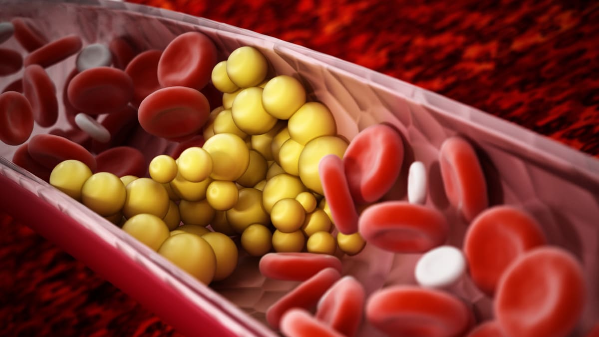 Cholesterol moving througth your body, stopping your blood.